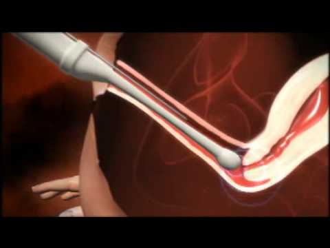 Insertion of semen with syringe into uterus