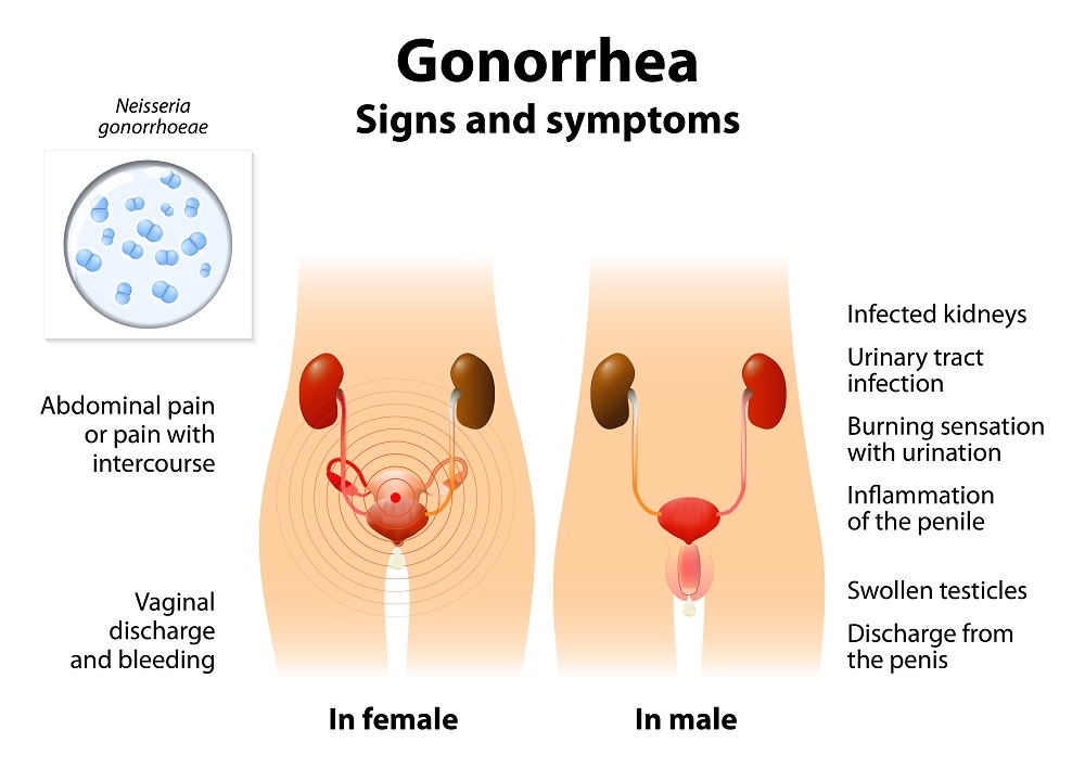 Gonorrhea on anus